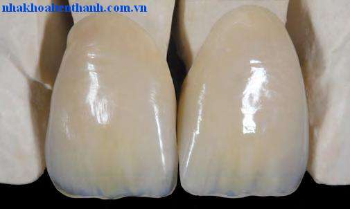 VITA VM 9 có chứa màu sắc để làm tăng độ phát quang, thể hiện được độ thẩm mỹ cao và kết quả như mong muốn.