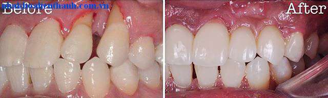 Khách hàng đã trải nghiệm sứ VITA