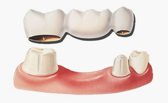 05141033_dental-bridge-cap-dr-muzzafar-zaman-2