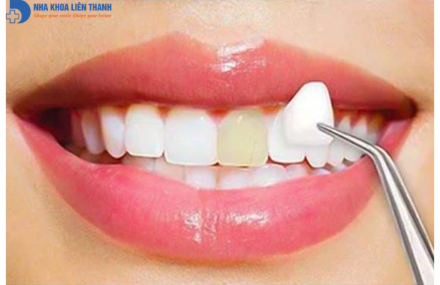 răng sứt mẻ