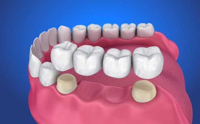 trồng răng Implant