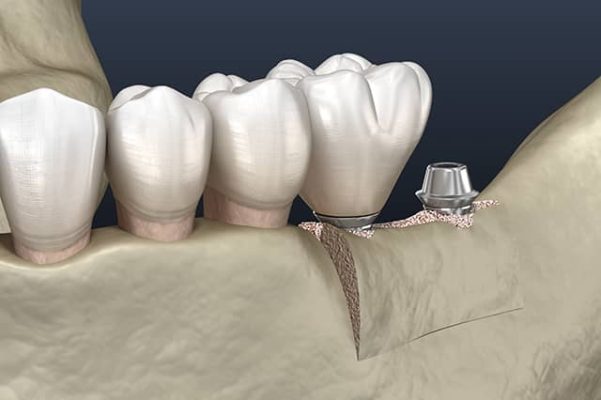 cấy ghép xương ổ răng trong cấy ghép Implant