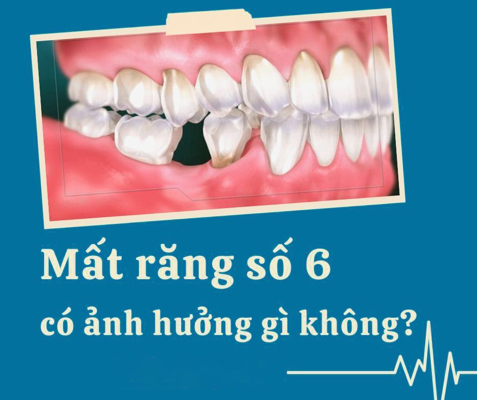 Có cách nào để khắc phục khoảng trống trên cung hàm sau khi nhổ răng số 6 không?
