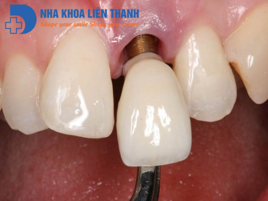 Implant Bi Dao Thai 1 Min
