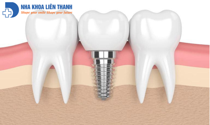 răng Implant 